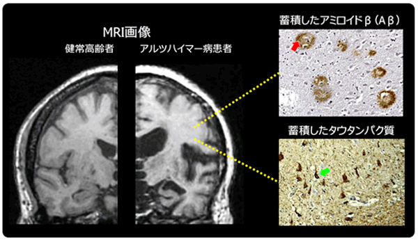 医療研究開発機構、アルツハイマー病における意欲低下の原因を