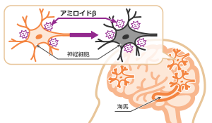 神経細胞とアミロイドβのイメージ